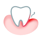 Biely zub s umiestnenou ružovou ďasnou a tenkou krvnou linkou.