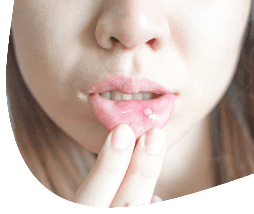 Žena sa jemne dotkne pery viditeľnou aftou.