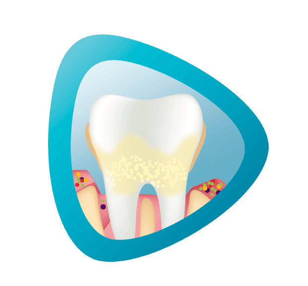 Zub obklopený modrým pozadím s viditeľnými mikroorganizmami na ďasnách.